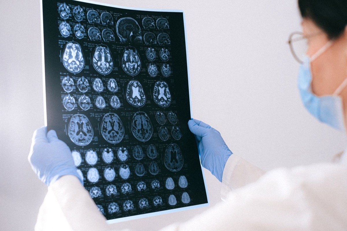 Beyin görüntüleme kesitlerini inceleyen klinik değerlendirme